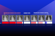 chest x-rays
